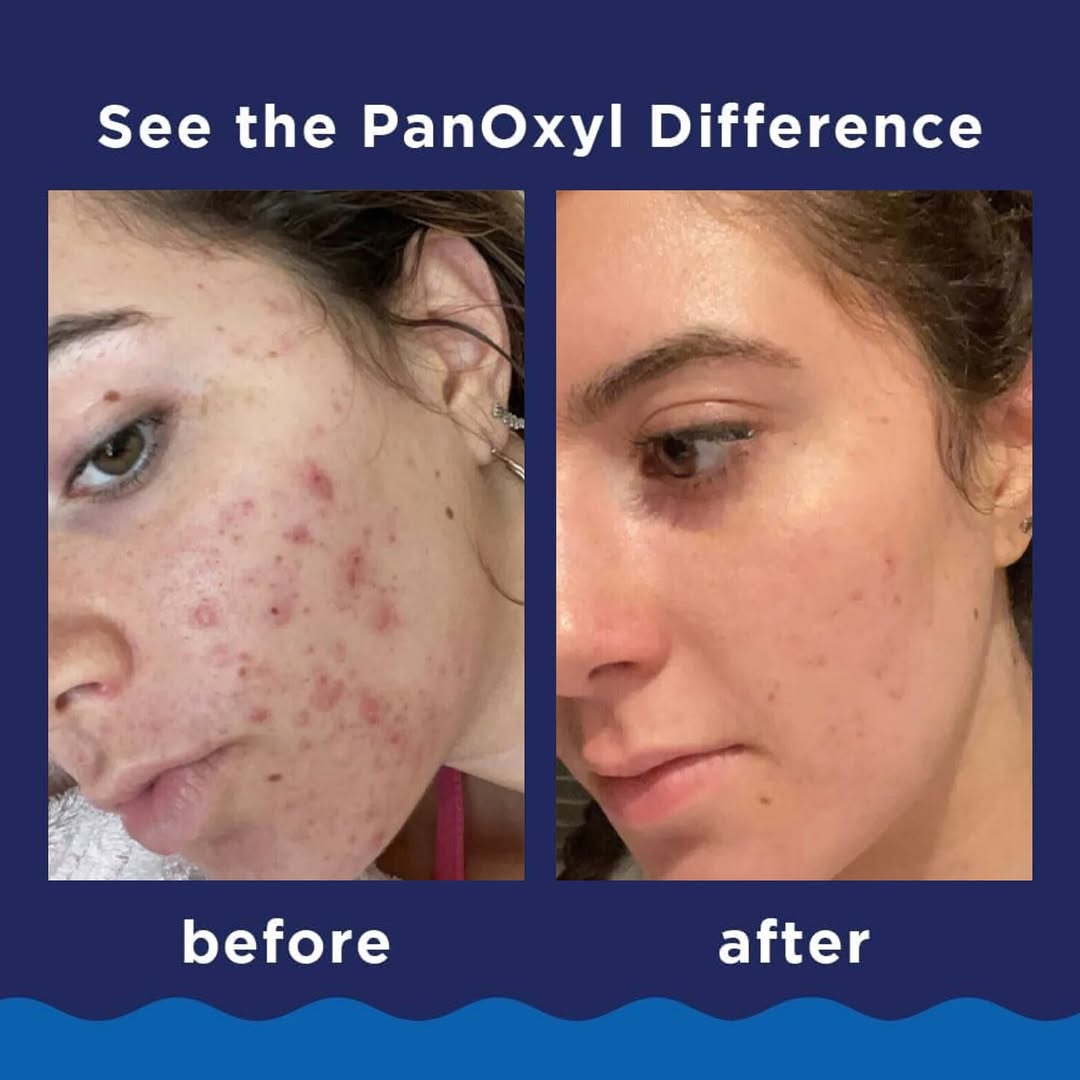 PanOxyl - Acne Foaming Wash Benzoyl Peroxide 10% - 156g